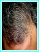 Grafts capillaries with surgery for baldness.