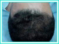 Hair implants and implants capillaries for baldness.