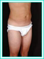 Liposuction body hips and abdomen with liposculpture.