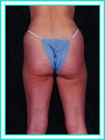 Lipoaspiration body and body liposculpture.