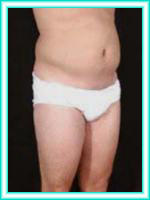 Hips with lipoaspiration by liposuction and liposculpture.