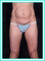 Liposuction of abdomen and rolls.
