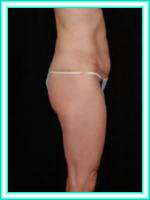 Liposuction for liposculpture of abdominal.