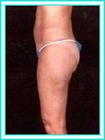 Abdomen with liposuction and liposculpture by lipoaspiration.