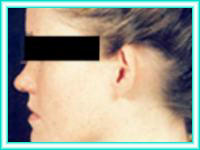 Otoplasty for ears with prominent nose surgery.