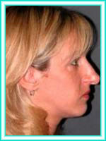 Facial surgery nose and operation of rhinoplasty surgery with aesthetics.