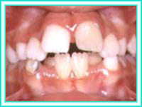 Adults with orthodontics centers aesthetics placement of brackets.