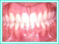 Brackets teeth in orthodontic dental aesthetics.