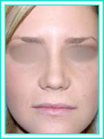 Cirugia estetica de nariz para estetica facial y operacion de tabique nasal.