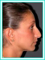 Cirugia estetica de nariz y cirugia plastica de nariz.