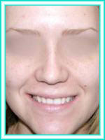 Cirugia de nariz y cirugia plastica para estetica facial de nariz.