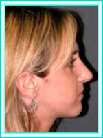 Cirugia plastica de tabique nasal para estetica facial y rinoplastia.