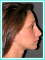 Operacion de tabique nasal y estetica facial con cirugia plastica.