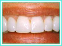 Orthodontics with tooth for tooth aesthetics.