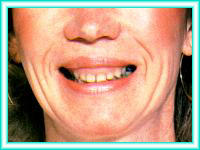 Aesthetic dental and orthodontic tooth whitening.