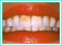 Tooth whitening and bleaching of teeth.