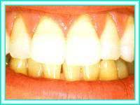 Bleaching of teeth and implants of white teeth.