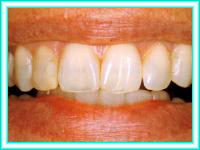 Bleaching of teeth with dental cleaning.