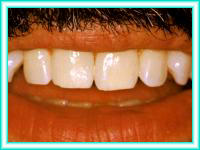 Bleaching of teeth and tooth whitening.