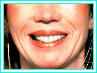 Bleaching of teeth with dental implants and aesthetics.