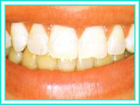 Clean teeth with tooth whitening.