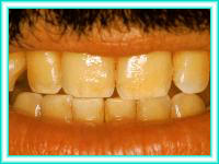 Orthodontics with dental implants for aesthetic.