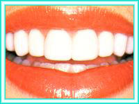 Tooth whitening and dental braces for aesthetics.