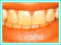 Implants teeth with orthodontics for dental aesthetics.