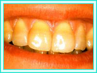 Bleaching teeth with teeth and cleaning teeth.