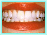 Bleaching teeth with orthodontics aesthetics.