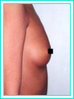 Implants of bosoms with surgery, operation for increase of breasts.