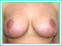 Elevation of breasts and breasts with silicone implants.