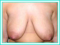 Silicone implants for breasts, breast surgery aesthetics.