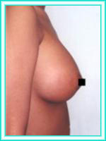 Increase of bosoms and bust with implants of silicones with operation.