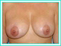 Surgery for aesthetics elevation of breasts.