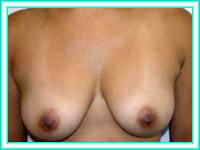 Surgery of increase of chests and bosoms.