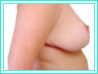 Surgery aesthetics to increase or reduction in breast bust.