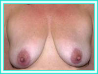 Silicone implants for breast and elevation.