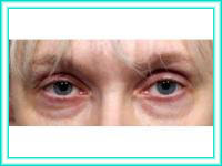 Wrinkles in the eyes of surgery with crow's feet and lifting.