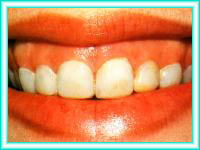 Dientes blancos con limpieza y blanqueamiento dental.