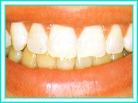 Limpieza dental con blanqueamiento de dientes.