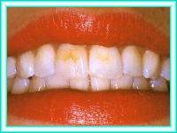 Blanqueamiento dental y blanqueamiento de dientes.