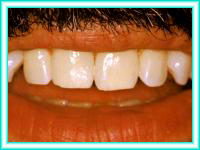 Blanqueamiento de dientes y blanqueamiento dental.