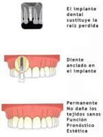 Implantes dentales en consultorios y clinica de odontologia.