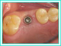 Odontologia estetica e implantes dentales en clinica de estetica.