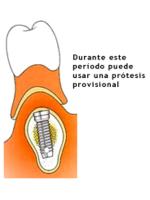 Implantes dentales en consultorios de odontologia y estetica.