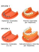 Dentales implantes en consultorios de clinica de estetica e implantes.