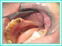Colocacion de implantes dentales en consultorios.