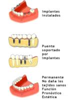 Implantes dentales con colocacion en consultorios de odontologia.
