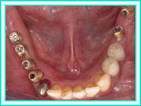 Dental implants in clinic placement and aesthetics.